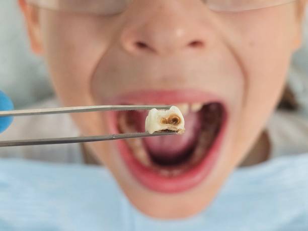 Best Emergency Tooth Extraction in Chestnut Ridge, NY